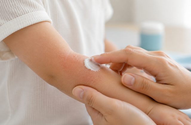 Eczéma et allergie : quel lien chez l’enfant ?